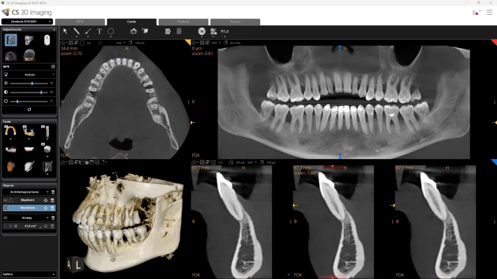 CS+8200+3D_12x10_Periodontitis_MPR_with+software